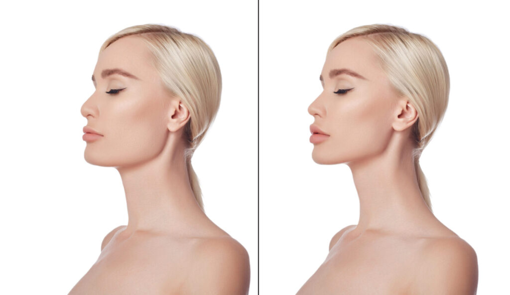 chin-augmentation-procedure-aspire-surgical-scaled
