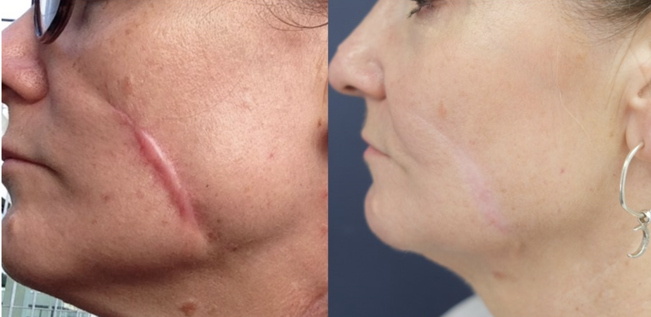 Laser scar removal cost discount